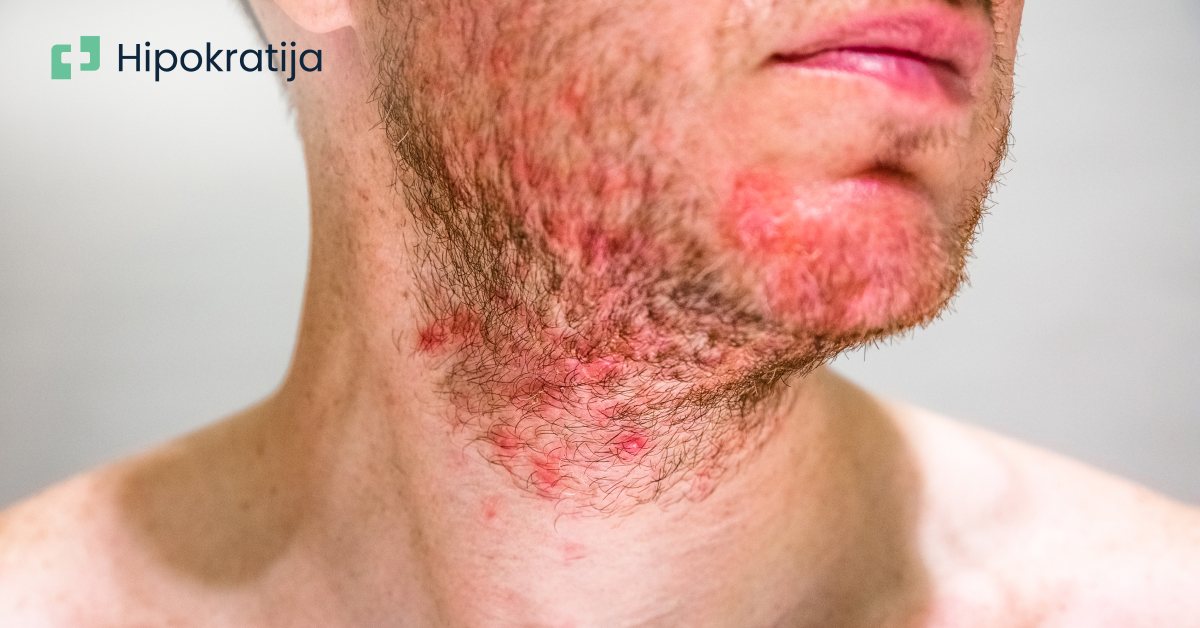 Seboroični dermatitis: Uzroci, simptomi i efikasni načini lečenja