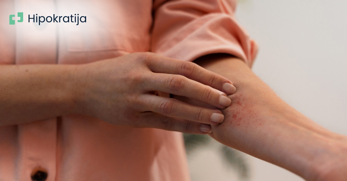 Boginje (varičele) kod odraslih: sve što bi trebalo da znate o ovom oboljenju