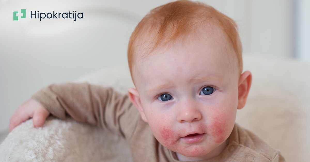 Atopijski dermatitis: Sve što treba da znate o ovoj upornoj kožnoj bolesti