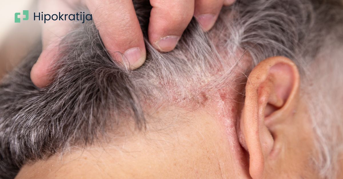 Psorijaza: Uzroci, simptomi i najefikasniji saveti